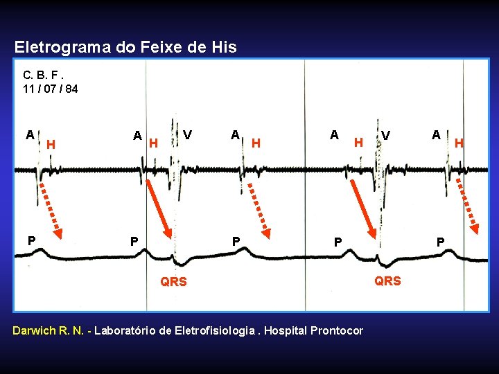 Eletrograma do Feixe de His C. B. F. 11 / 07 / 84 A