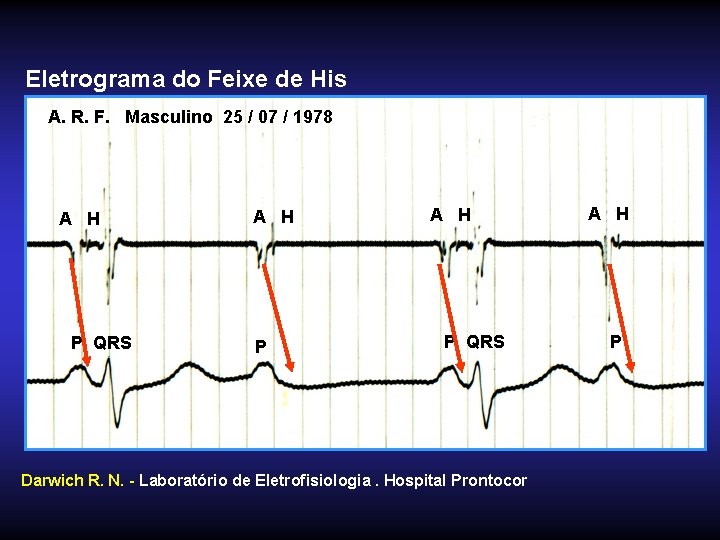 Eletrograma do Feixe de His A. R. F. Masculino 25 / 07 / 1978