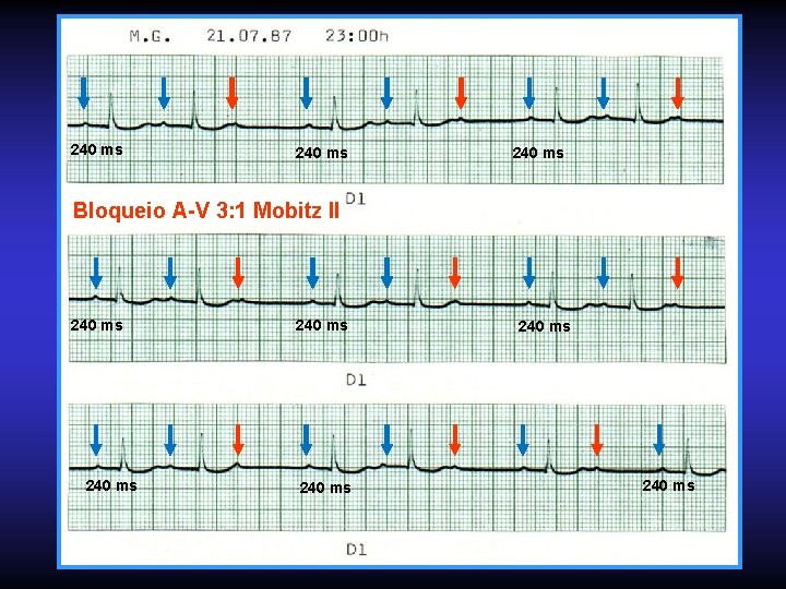 240 ms Bloqueio A-V 3: 1 Mobitz II 240 ms 240 ms 