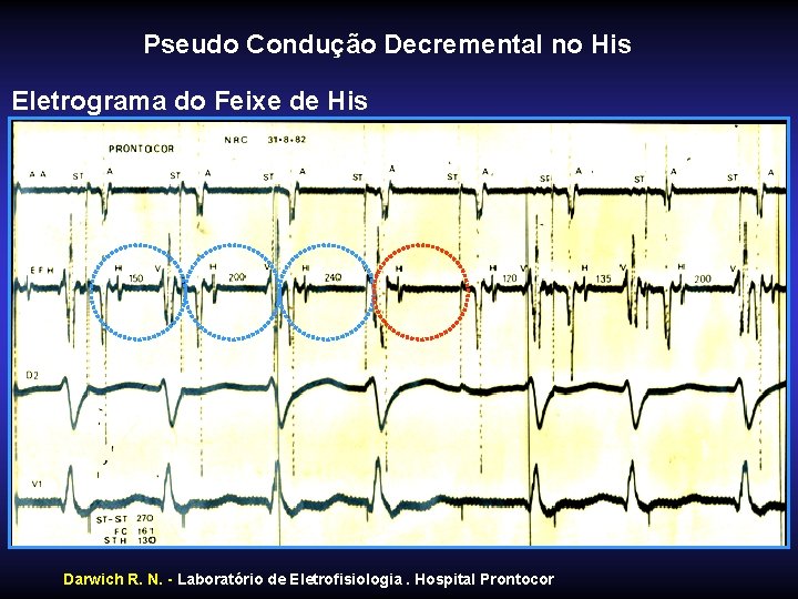 Pseudo Condução Decremental no His Eletrograma do Feixe de His Darwich R. N. -