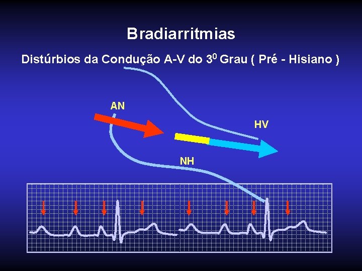 Bradiarritmias Distúrbios da Condução A-V do 30 Grau ( Pré - Hisiano ) AN