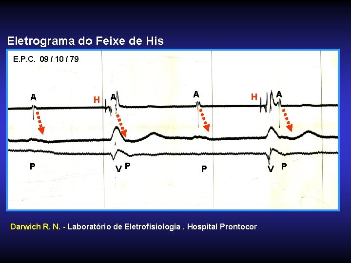 Eletrograma do Feixe de His E. P. C. 09 / 10 / 79 A
