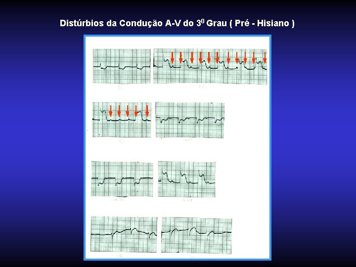 Distúrbios da Condução A-V do 30 Grau ( Pré - Hisiano ) 