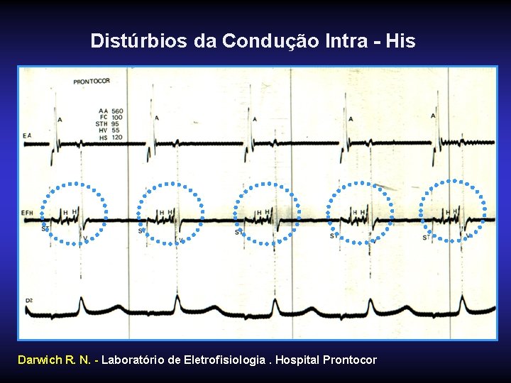 Distúrbios da Condução Intra - His Darwich R. N. - Laboratório de Eletrofisiologia. Hospital