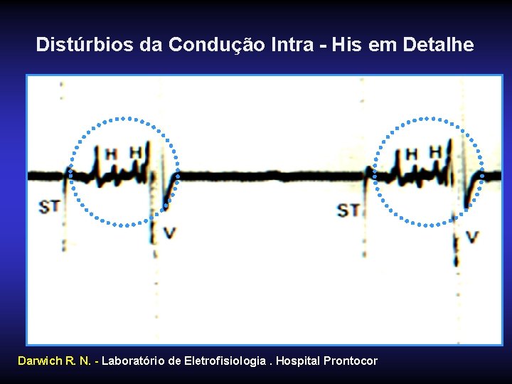 Distúrbios da Condução Intra - His em Detalhe Darwich R. N. - Laboratório de