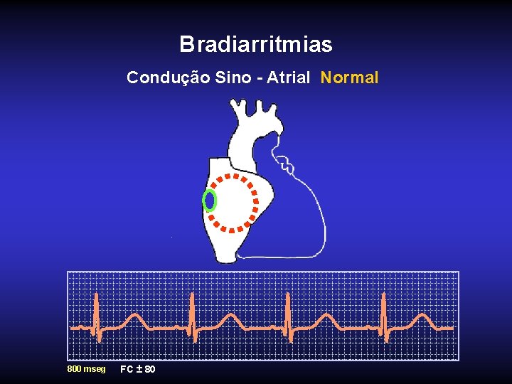 Bradiarritmias Condução Sino - Atrial Normal 800 mseg FC ± 80 