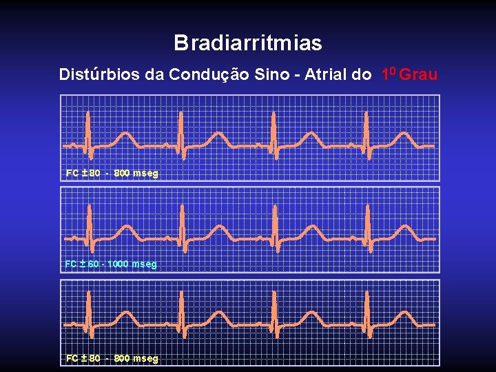 Bradiarritmias Distúrbios da Condução Sino - Atrial do 10 Grau FC ± 80 -