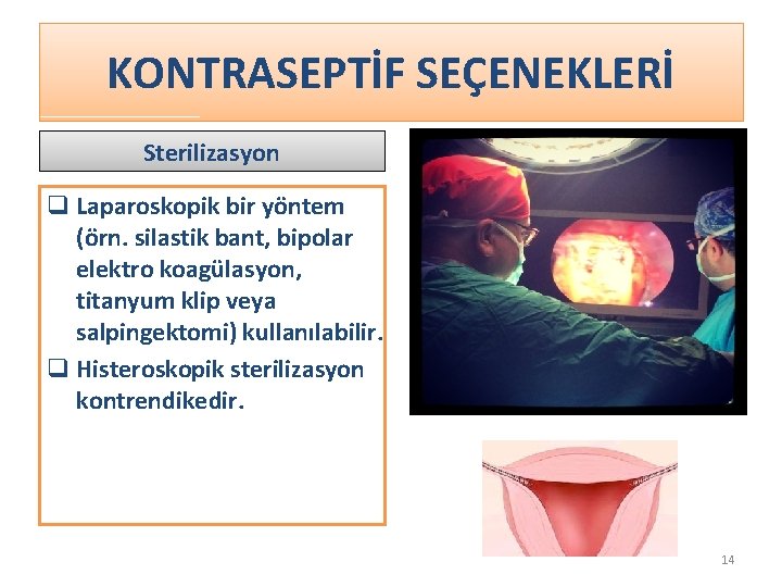 KONTRASEPTİF SEÇENEKLERİ Sterilizasyon q Laparoskopik bir yöntem (örn. silastik bant, bipolar elektro koagülasyon, titanyum