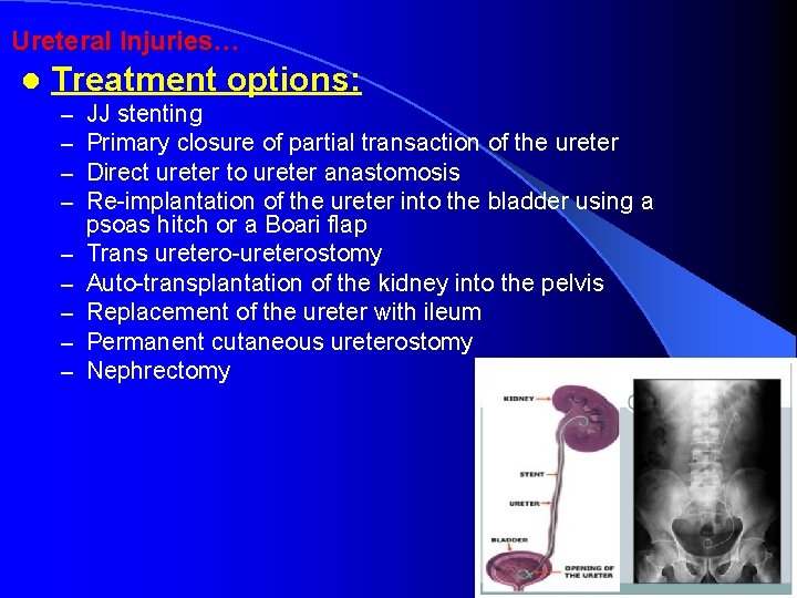 Ureteral Injuries… l Treatment options: – – – – – JJ stenting Primary closure