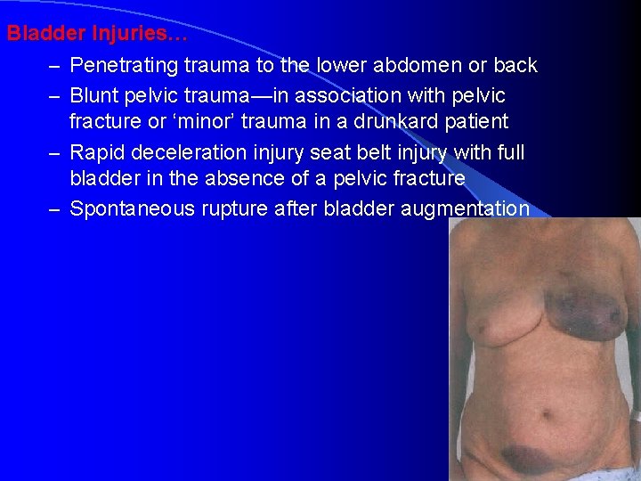 Bladder Injuries… – Penetrating trauma to the lower abdomen or back – Blunt pelvic