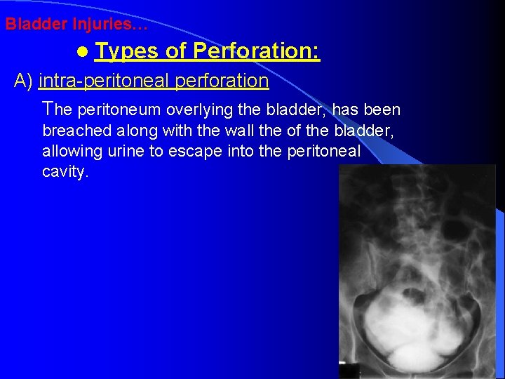 Bladder Injuries… l Types of Perforation: A) intra-peritoneal perforation The peritoneum overlying the bladder,