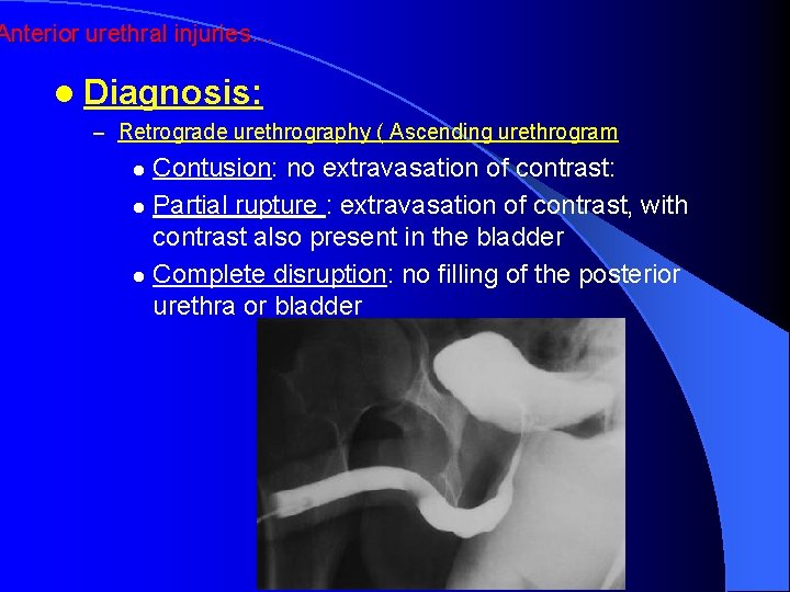 Anterior urethral injuries… l Diagnosis: – Retrograde urethrography ( Ascending urethrogram Contusion: no extravasation