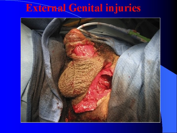 External Genital injuries 