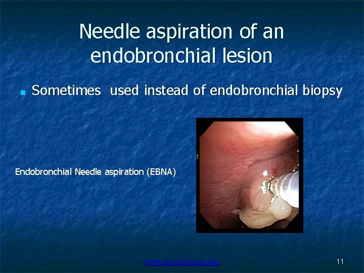 Needle aspiration of an endobronchial lesion ■ Sometimes used instead of endobronchial biopsy Endobronchial