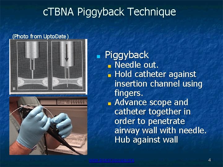 c. TBNA Piggyback Technique (Photo from Upto. Date) ■ Piggyback ■ ■ ■ Needle