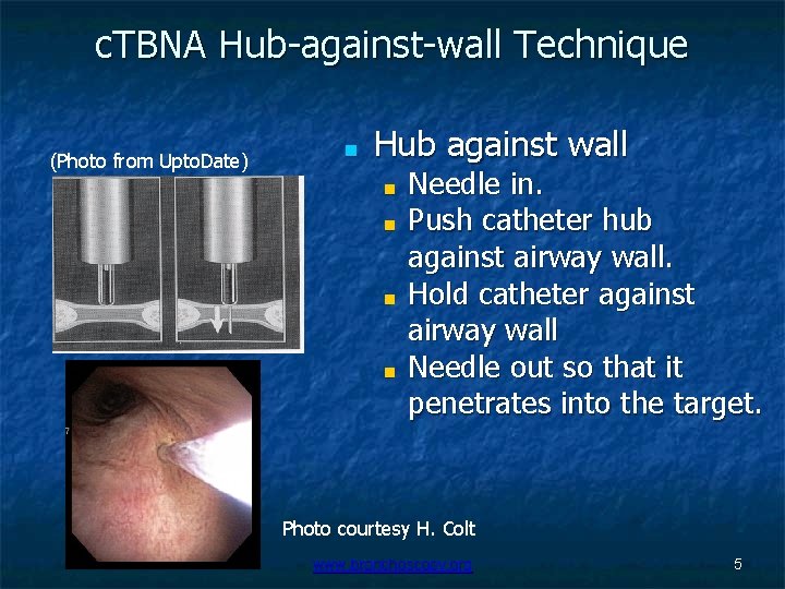 c. TBNA Hub-against-wall Technique (Photo from Upto. Date) ■ Hub against wall ■ ■