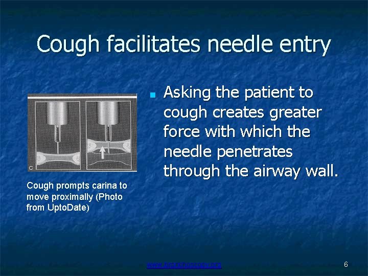 Cough facilitates needle entry ■ Cough prompts carina to move proximally (Photo from Upto.