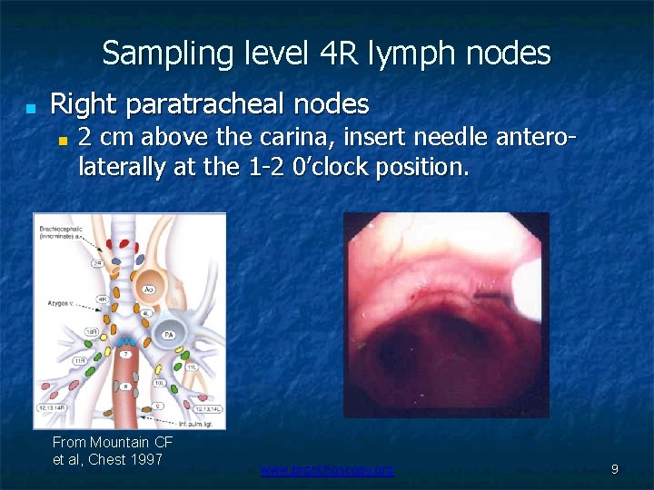 Sampling level 4 R lymph nodes ■ Right paratracheal nodes ■ 2 cm above