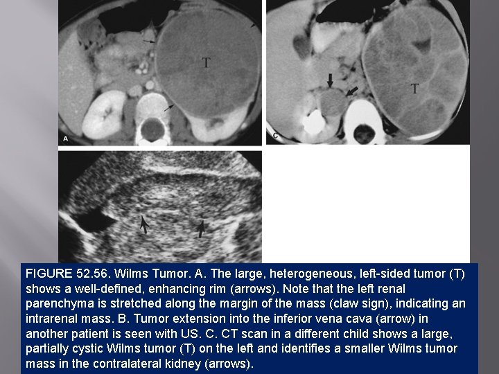 FIGURE 52. 56. Wilms Tumor. A. The large, heterogeneous, left-sided tumor (T) shows a