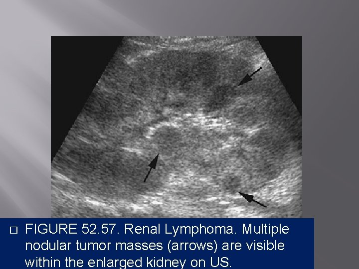 � FIGURE 52. 57. Renal Lymphoma. Multiple nodular tumor masses (arrows) are visible within