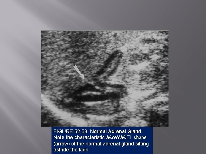 FIGURE 52. 58. Normal Adrenal Gland. Note the characteristic â€œYâ€� shape (arrow) of the