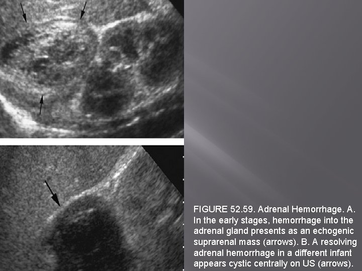 FIGURE 52. 59. Adrenal Hemorrhage. A. In the early stages, hemorrhage into the adrenal