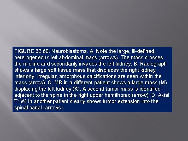 FIGURE 52. 60. Neuroblastoma. A. Note the large, ill-defined, heterogeneous left abdominal mass (arrows).