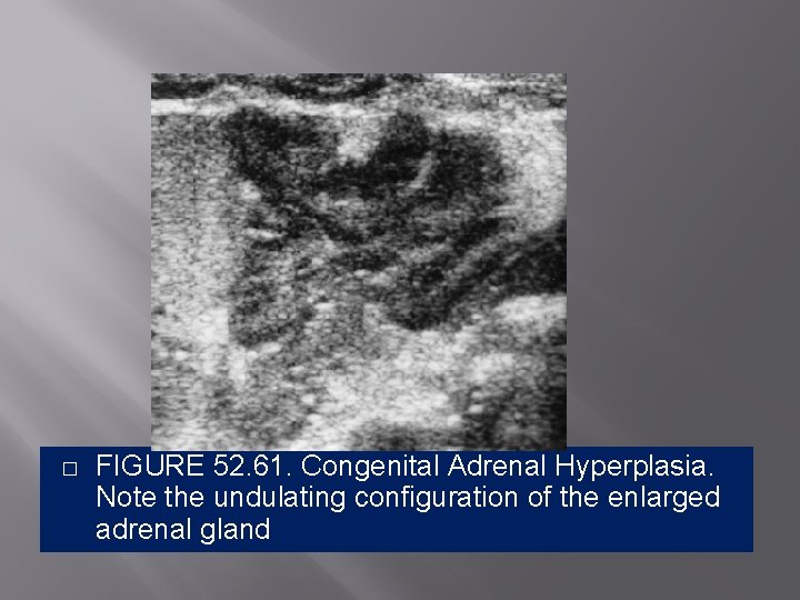 � FIGURE 52. 61. Congenital Adrenal Hyperplasia. Note the undulating configuration of the enlarged