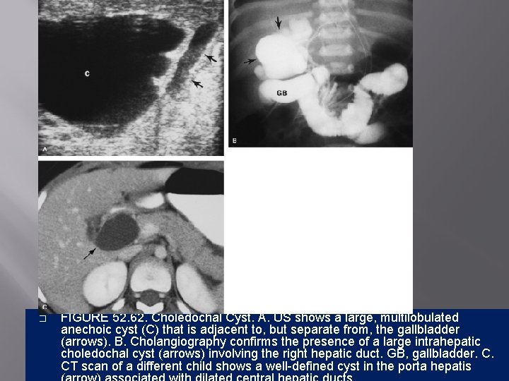� FIGURE 52. 62. Choledochal Cyst. A. US shows a large, multilobulated anechoic cyst