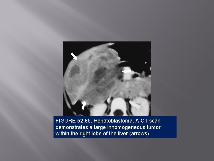 FIGURE 52. 65. Hepatoblastoma. A CT scan demonstrates a large inhomogeneous tumor within the
