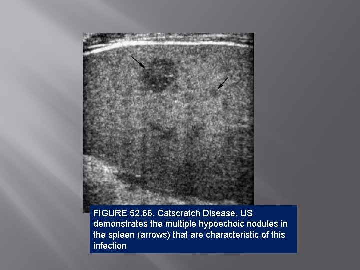 FIGURE 52. 66. Catscratch Disease. US demonstrates the multiple hypoechoic nodules in the spleen