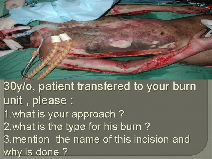 30 y/o, patient transfered to your burn unit , please : 1. what is
