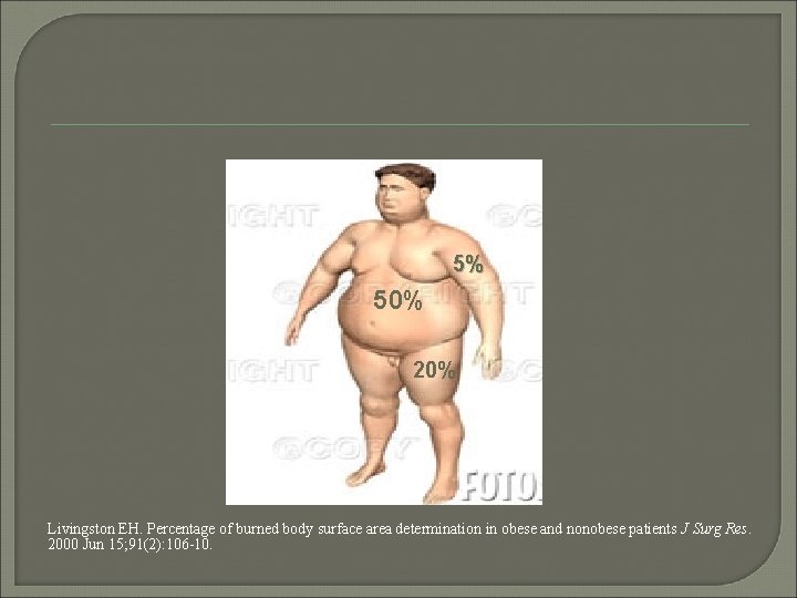 5% 50% 20% Livingston EH. Percentage of burned body surface area determination in obese