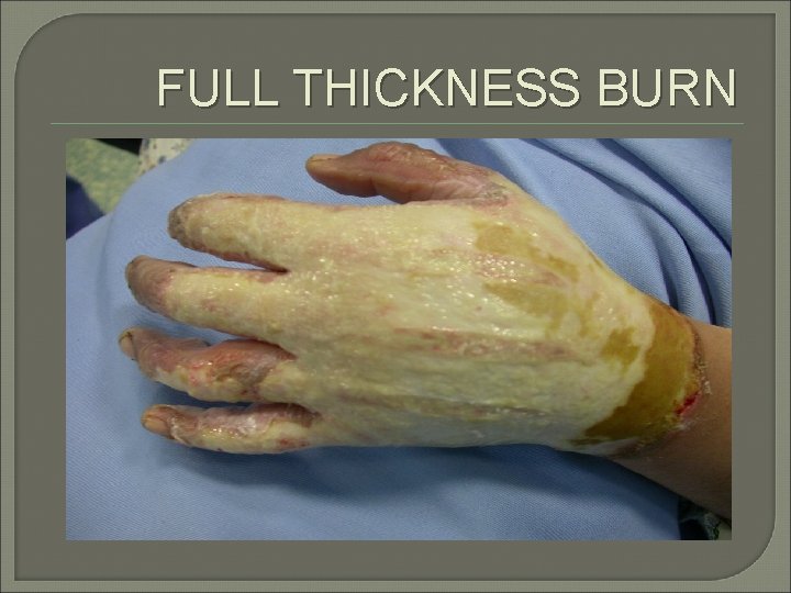 FULL THICKNESS BURN 