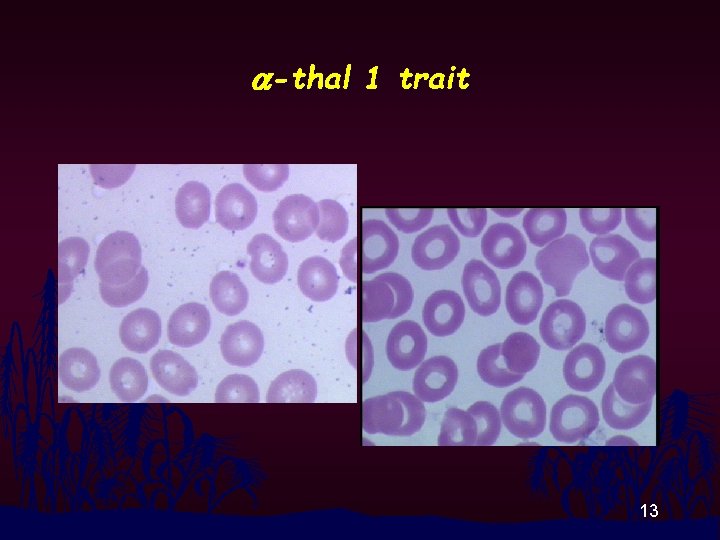 a-thal 1 trait 13 