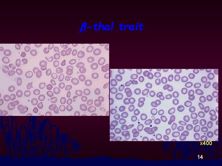 b-thal trait x 400 14 