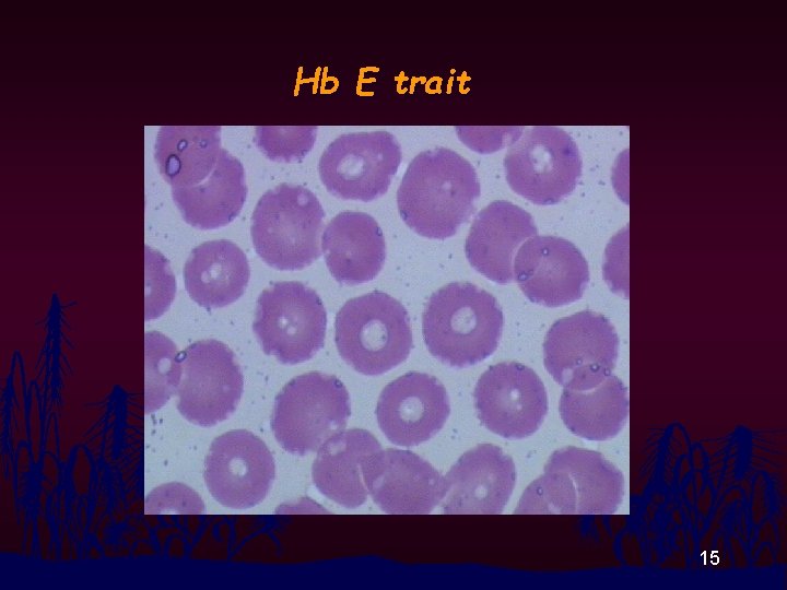 Hb E trait 15 