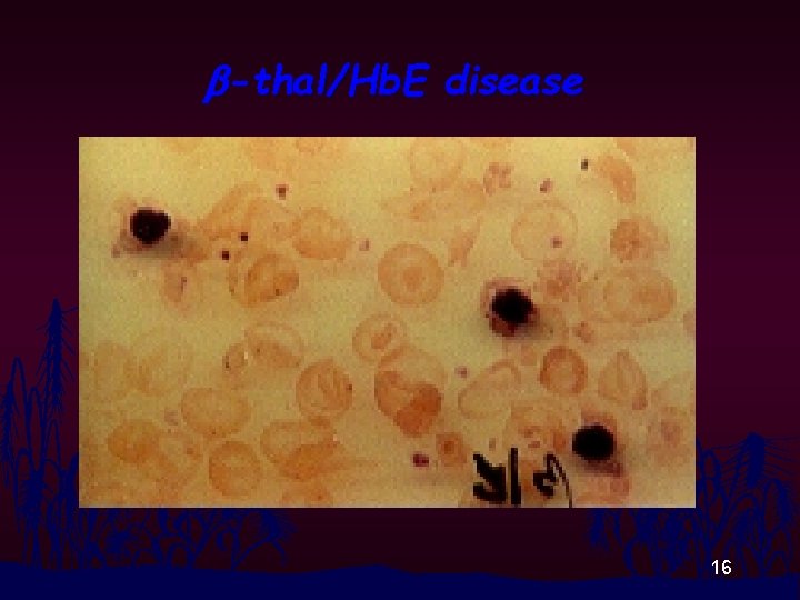 b-thal/Hb. E disease 16 