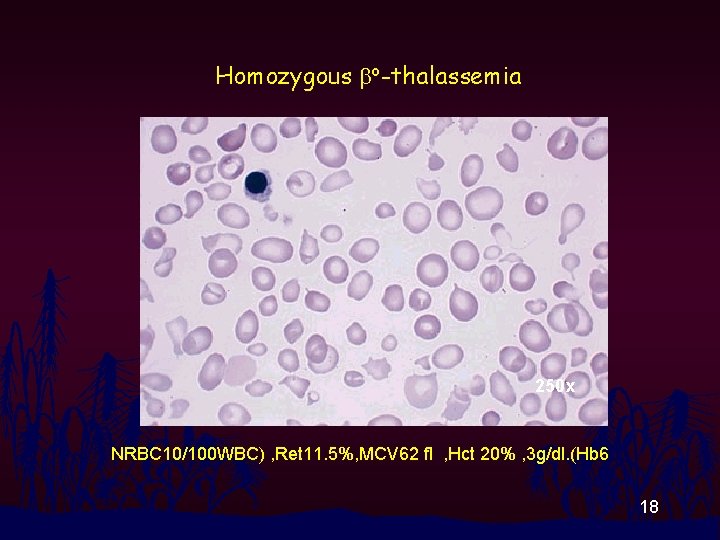 Homozygous bo-thalassemia 250 x NRBC 10/100 WBC) , Ret 11. 5%, MCV 62 fl