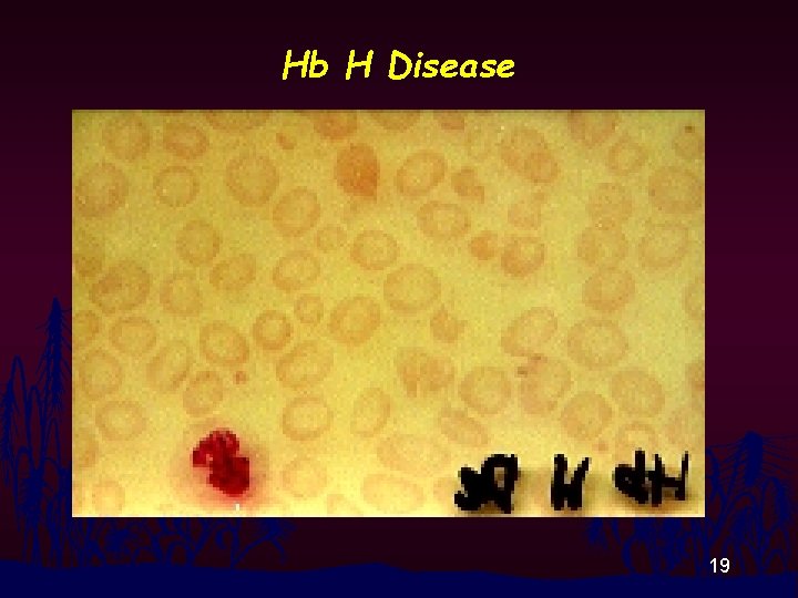Hb H Disease 19 