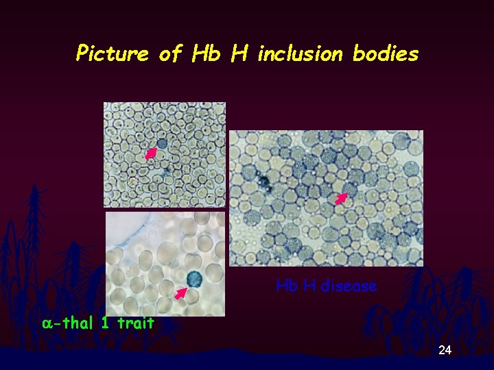 Picture of Hb H inclusion bodies Hb H disease a-thal 1 trait 24 