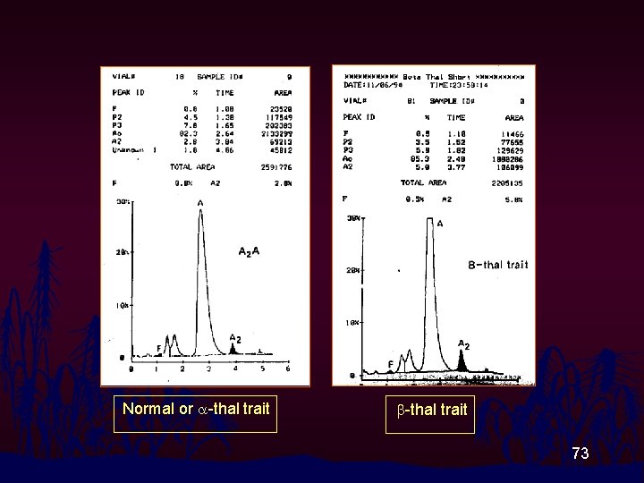 Normal or a-thal trait b-thal trait 73 