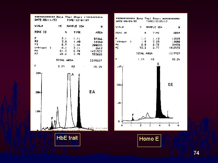 Hb. E trait Homo E 74 