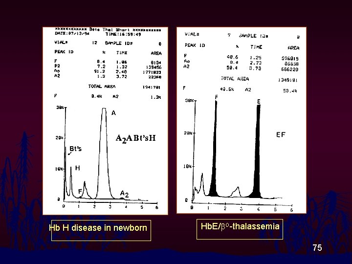 Hb H disease in newborn Hb. E/b. O-thalassemia 75 