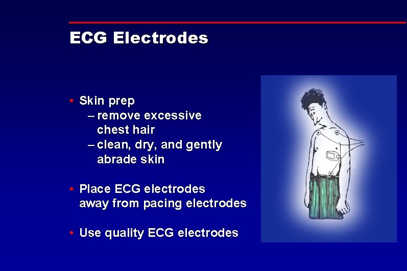 ECG Electrodes • Skin prep – remove excessive chest hair – clean, dry, and