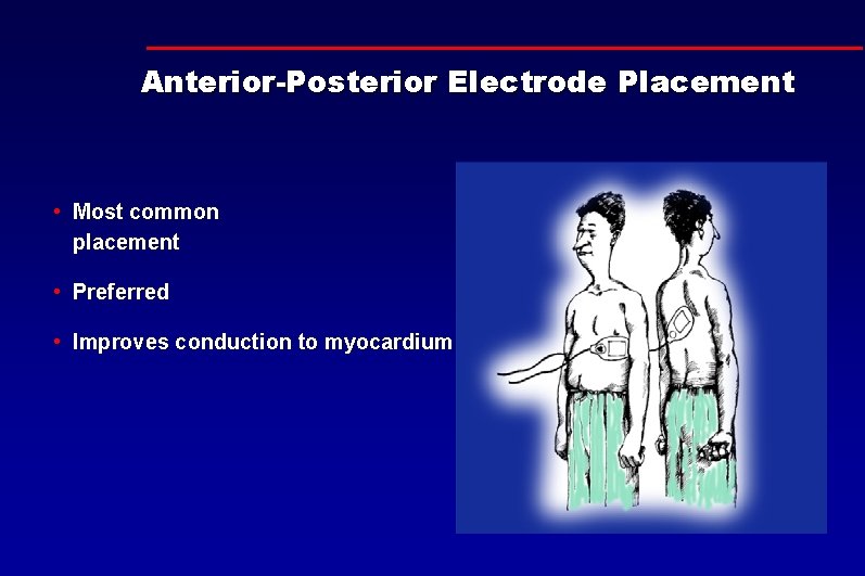 Anterior-Posterior Electrode Placement • Most common placement • Preferred • Improves conduction to myocardium