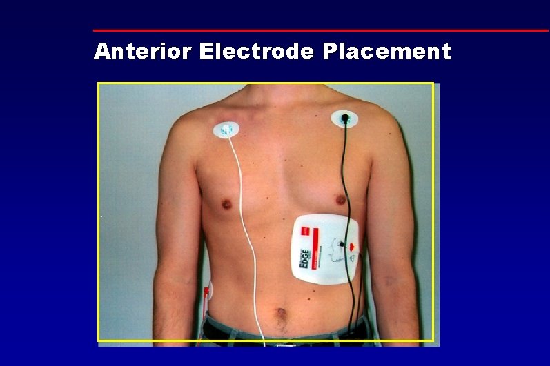 Anterior Electrode Placement 
