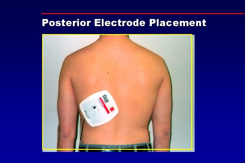 Posterior Electrode Placement 