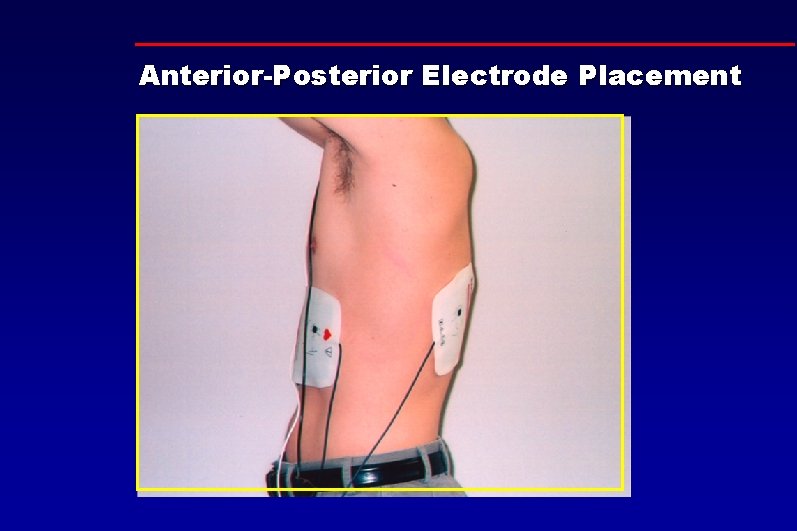 Anterior-Posterior Electrode Placement 