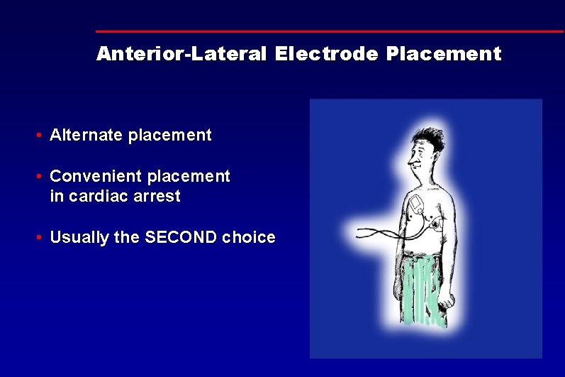 Anterior-Lateral Electrode Placement • Alternate placement • Convenient placement in cardiac arrest • Usually